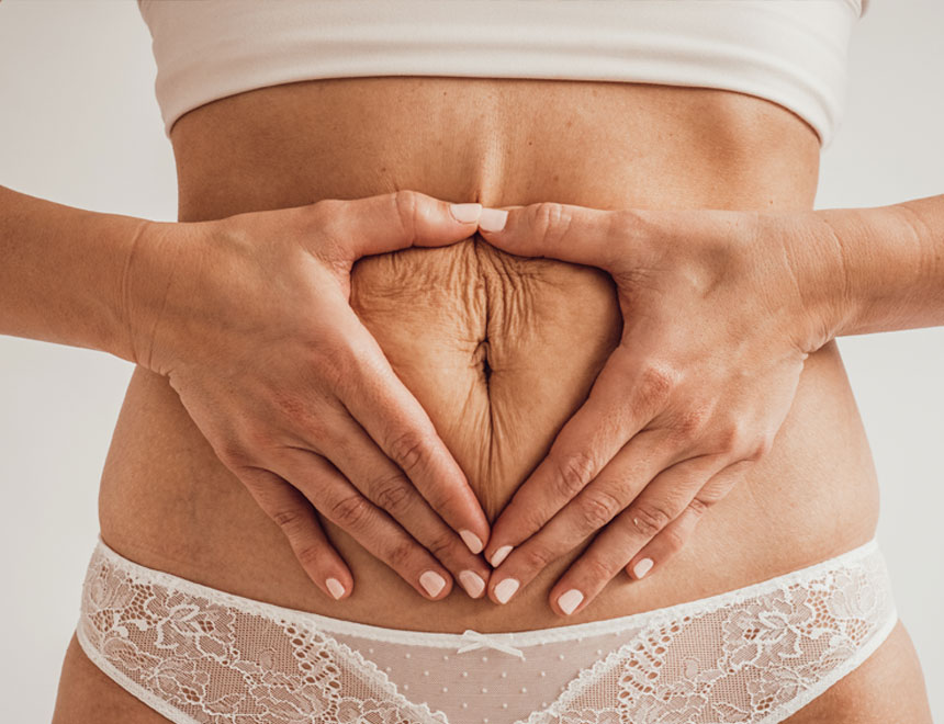 Mujer con diástasis abdominal